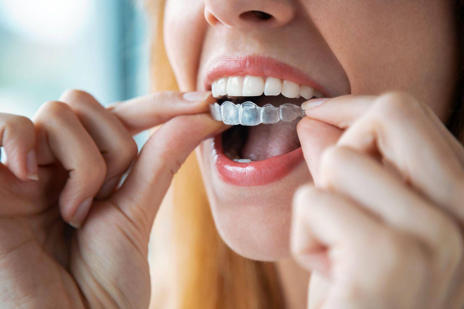 Invisalign in Madison Heights
