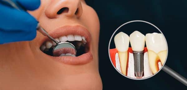 dental implants in Sterling Heights