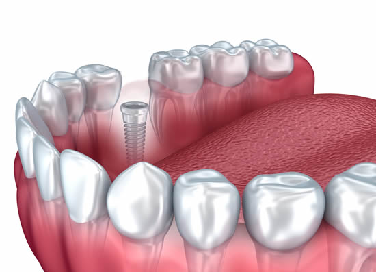 dental implants in royal oak