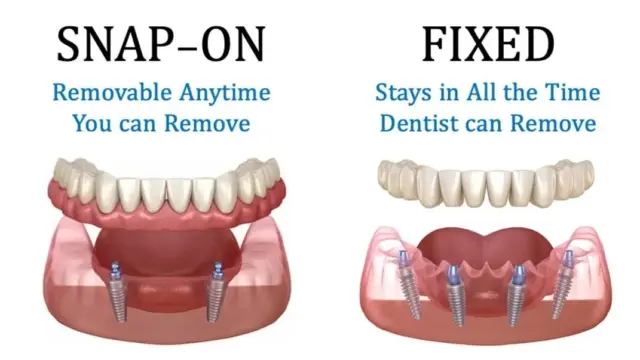 Removable Implant-Supported Dentures