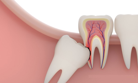 Tooth Extraction in Madison Heights | Arch Dental