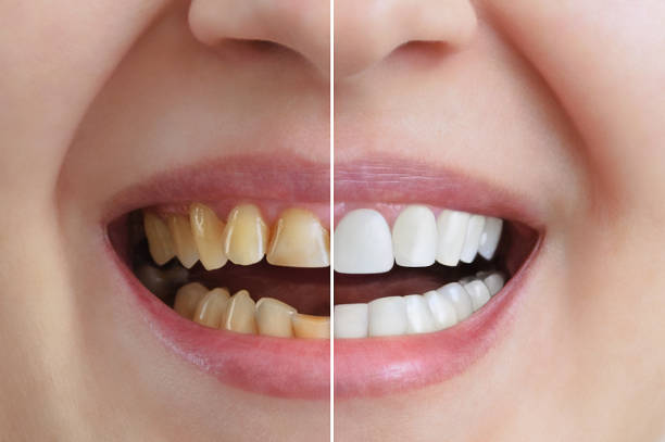 Teeth Whitening in Hazel Park