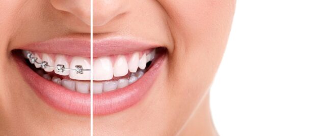 Orthodontic Treatment in madison heights