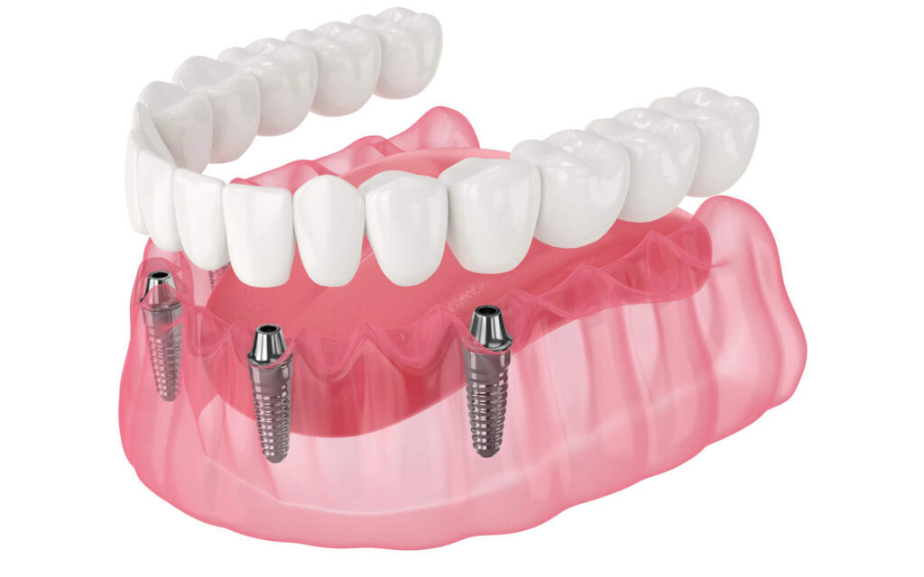All-on-X Dental Implants in Madison Heights | Arch Dental