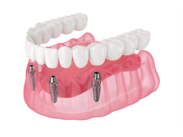 all on x dental madison heights